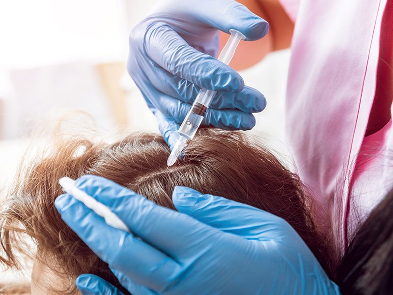prp microneedling gallery 04